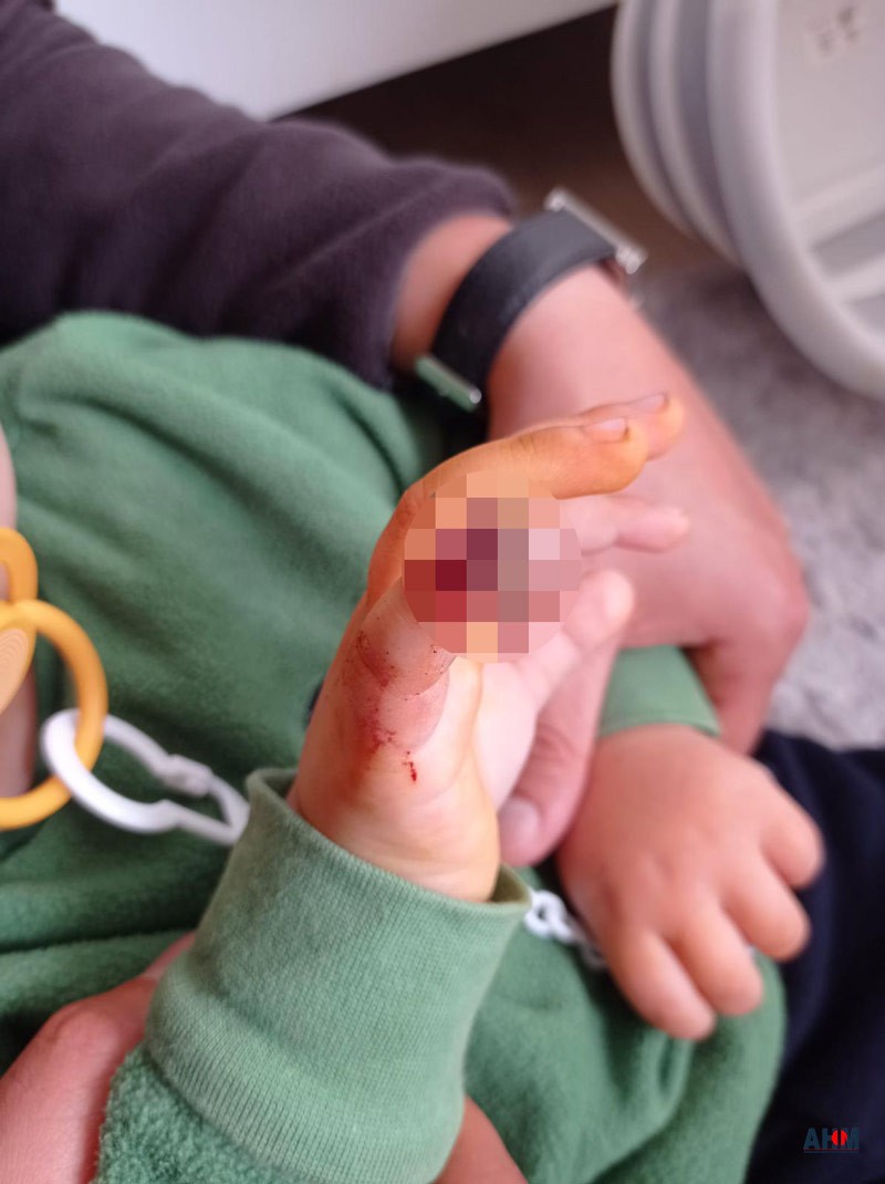 Adana'da Anaokulunda Skandal. 3 Yaşındaki Çocuğun Parmağı Koptu!